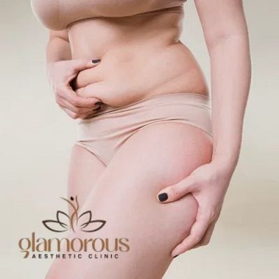 Does Liposuction Tighten Loose Skin?