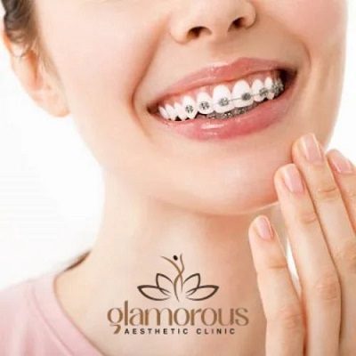 How much do braces cost in Islamabad?