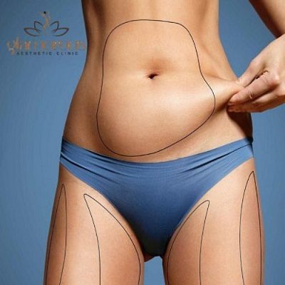 Liposuction vs Tummy Tuck – Which One Is Best in Islamabad