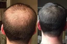 PRP Hair Treatment before & After