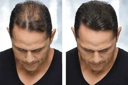 PRP Hair Treatment before & After