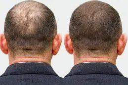 PRP Hair Treatment in islamabad