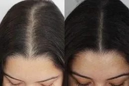 PRP Hair Treatment islamabad