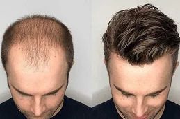 PRP Hair Treatment islamabad