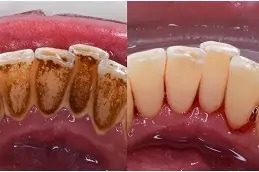 Teeth Scaling and Polishing before & After