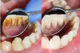 Teeth Scaling and Polishing before & After