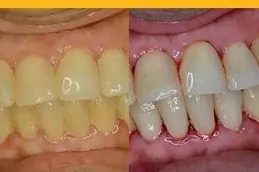 Teeth Scaling and Polishing clinic in islamabad