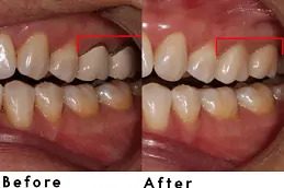 Teeth Scaling and Polishing clinic in islamabad