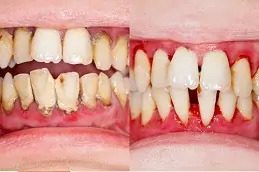 Teeth Scaling and Polishing in islamabad