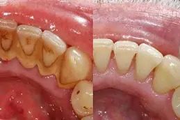 Teeth Scaling and Polishing islamabad