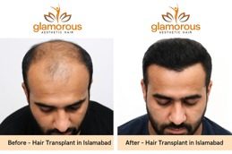 hair transplant before & After
