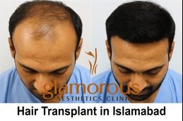 hair transplant before & After.