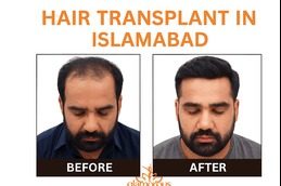 hair transplant clinic before & After