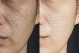 Chemical Skin Peels before & after,