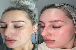 Chemical Skin Peels clinic before & after,
