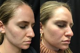 Chemical Skin Peels clinic before & after