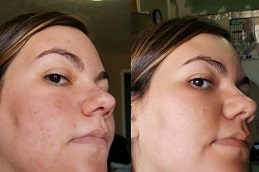 Chemical Skin Peels clinic in islamabad