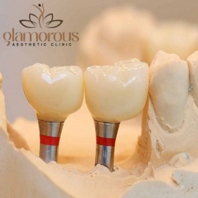 How Much Do Ceramic Crowns Cost In Islamabad?