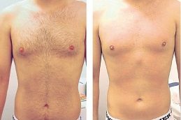 Laser Hair Removal Clinic before & After in Islamabad