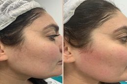 Laser Hair Removal Clinic in Islamabad.