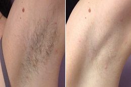 Laser Hair Removal Clinic in Islamabad