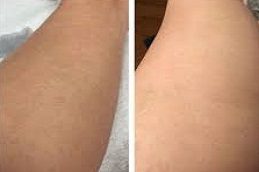 Laser Hair Removal Islamabad