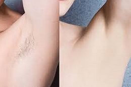 Laser Hair Removal before & After