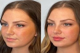 Lip Fillers Injections clinic in islamabad,