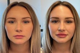 Lip Fillers Injections clinic in islamabad