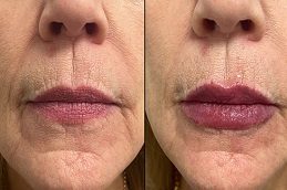 Lip Fillers before & After in islamabad