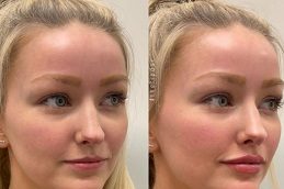 Lip Fillers in islamabad.