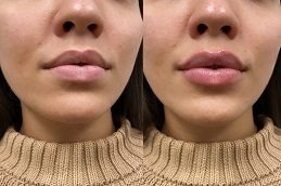 Lip Fillers in islamabad