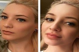 Lip Fillers in islamabad