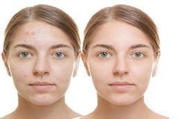 Best HydraFacial before & After clinic in Islamabad