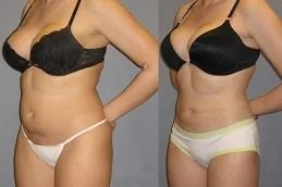 Best liposuction results Islamabad - before and after full body contouring at Glamorous Aesthetic Clinic
