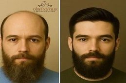 Results of Hair Transplant Cost in Islamabad: