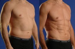 Love handles removal liposuction before after - body contouring results at best clinic Islamabad