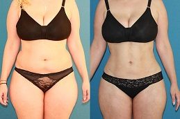 Natural liposuction results before and after - safe body sculpting by triple board certified surgeon Islamabad