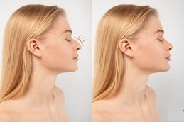 Rhinoplasty Clinic before & After In Rawalpindi pakistan
