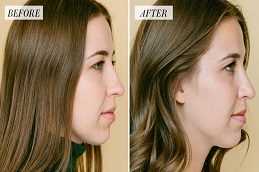 Rhinoplasty Clinic before & After In Rawalpindi