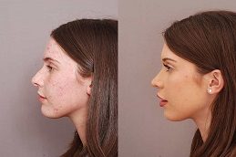 Rhinoplasty Clinic before & After In Pakistan
