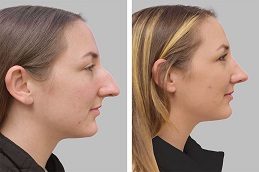 Rhinoplasty Clinic before & After