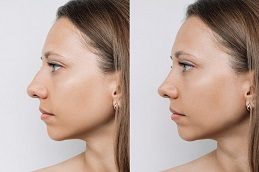 Rhinoplasty before & After In Rawalpindi