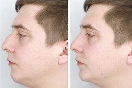 Rhinoplasty before & After In islamabad