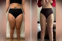 Thigh liposuction before after photos showing slim contoured legs - Glamorous Clinic Pakistan