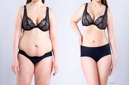 Tummy Tuck clinic before & After