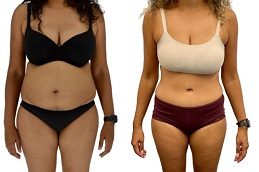 Tummy Tuck clinic islamabad