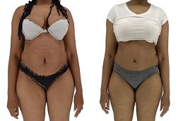 Tummy Tuck in clinic islamabad