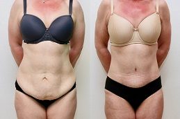 Tummy Tuck in islamabad