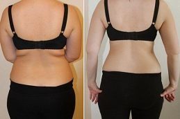 mounjaro injection before & After clinic in islamabad